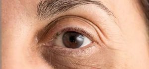 چروک زود هنگام گوشه چشم یکی دیگر از نشانه های هست ک بدن نیاز به پاکسازی داره